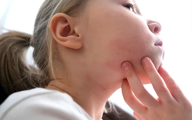 child with atopic dermatitis