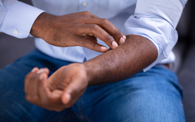 Man scratching his arm skin of colour disease psoriasis
