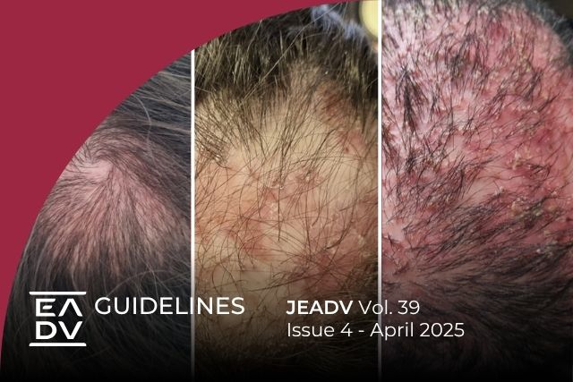 Folliculitis Decalvans EADV Hair Diseases Guidelines