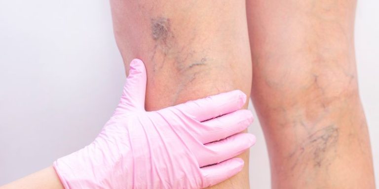 EADV course introduction in phlebology with hands on training