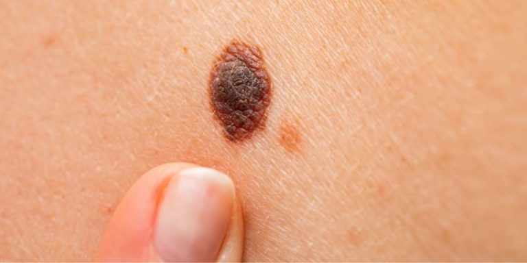 EADV Course melanoma surgery