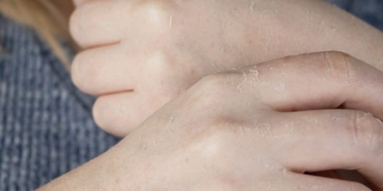 eadv course Cutaneous mycoses: New developments in diagnosis and treatment