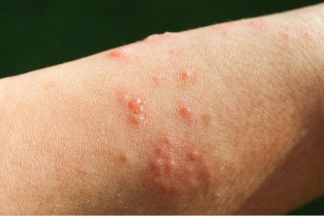 Bullous disease dermatology