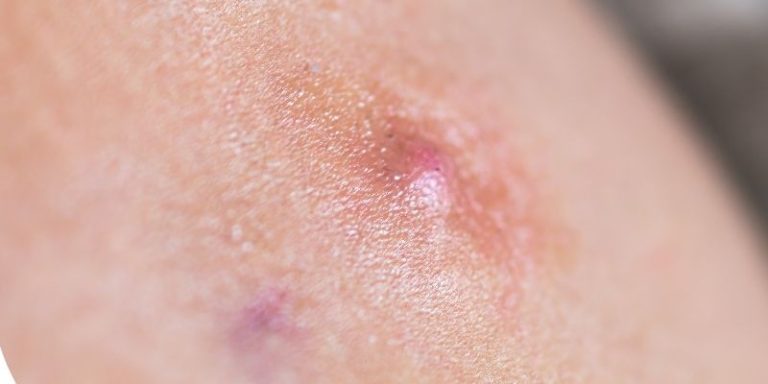 EADV course Hidradenitis suppurativa: Current status and developments