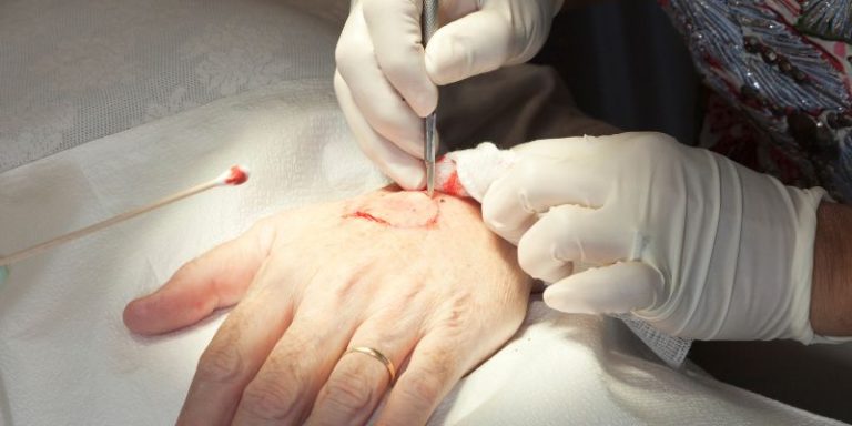 EADV course Mohs micrographic surgery, a tool in skin cancer treatment