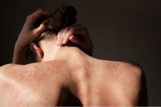 Psoriasis Sessions at the EADV Congress 2025 - Paris