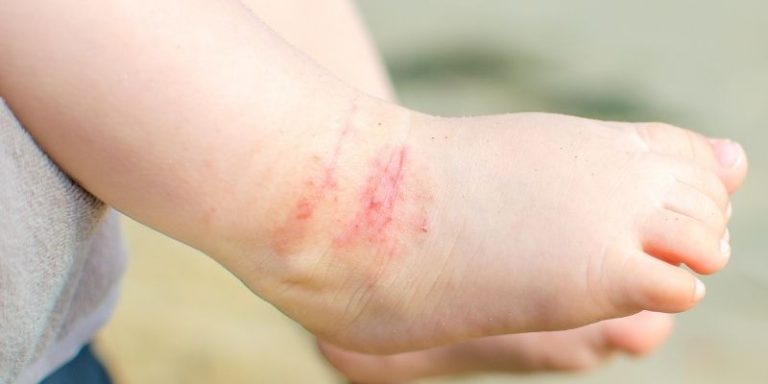 EADV course Treatment of the common skin diseases in children: how to avoid pitfalls - pearls and tips