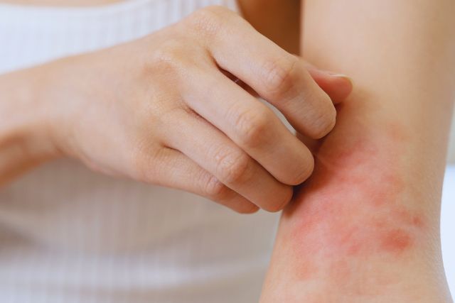 closeup of patient suffering from atopic dermatitis EADV