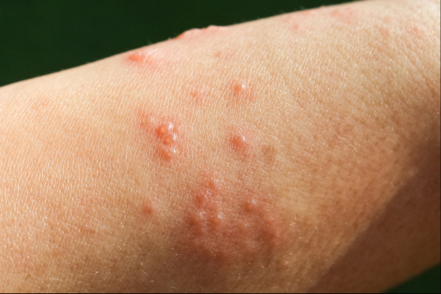 bullous skin disease